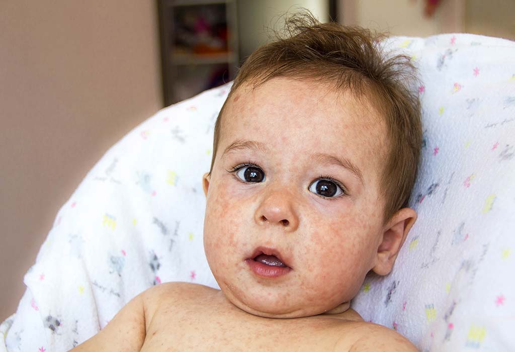 Does Skin Discoloration in Babies Signal Serious Problem?