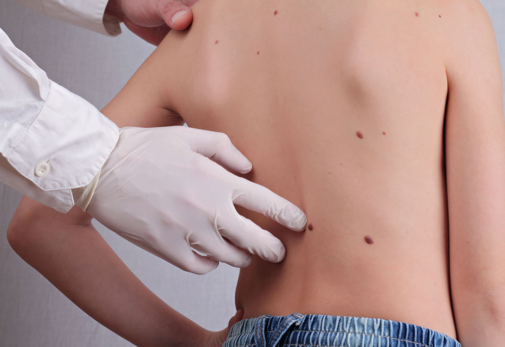 Skin Tags in Children - Causes and Treatment